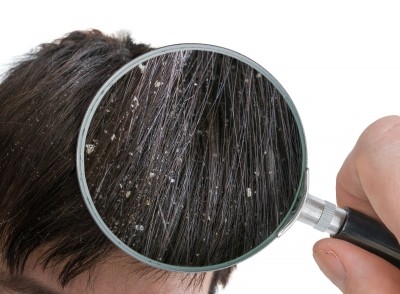 2024 Dandruff Care Trends © vchal Getty Images